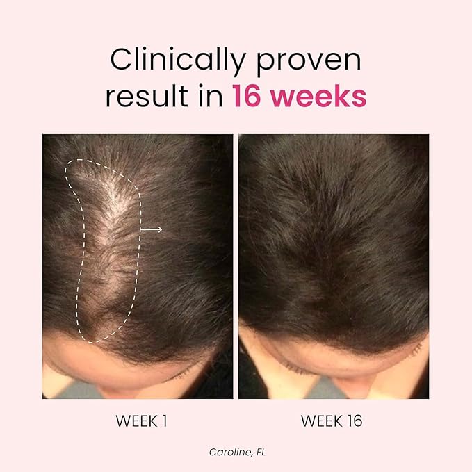 Trybello Anti-Stress & Hair Growth Gummies for Women | Sugar-Free, Vegan Hair Supplements | Gluten-Free, Soy-Free, Dairy-Free Gummy Vitamins for Thicker, Healthier Hair | 60 Servings | 2 Pack Combo