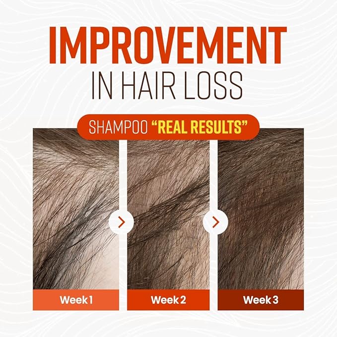 CRAZY SKIN German Beers Yeast Biotin Shampoo for Hard water, Anti-hair loss, and Thickening,Gentle Exfoliating & Scalp Function with Panthenol, Collagen and Free-Sulfate, Chemical, 300ml(10.15oz)