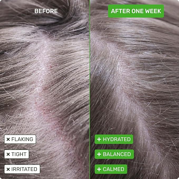 Ethique Beauty Scalp Health Shampoo & Conditioner Bar Set for Dry, Flakey, & Itchy Scalps