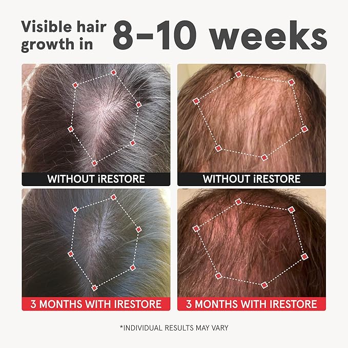 iRestore Advanced Hair Growth Supplement for Women with Lustriva, Hair Vitamins for Faster Hair Regrowth, Best for Hair Loss and Thinning, 1 Month Supply - 1 Count (Pack of 1) - Black