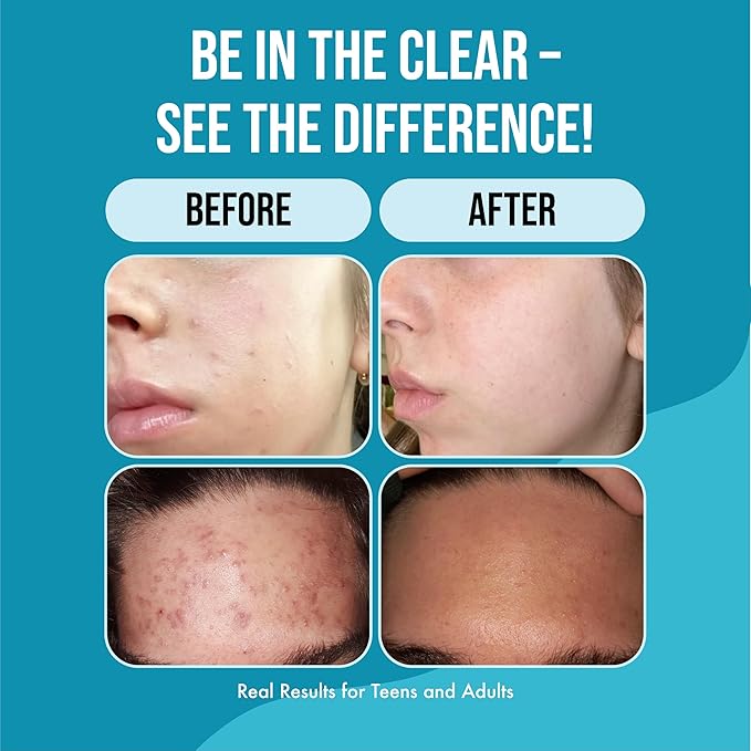 Teenology Teen Shampoo – Avoid Acne Breakouts, Non-Comedogenic, For Dry & Oily Scalps, Sulfate & Paraben Free, Natural Botanical Extracts, for Clear Skin & Healthy Hair, 16 oz – (Papaya)