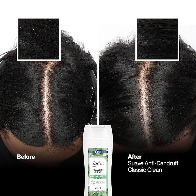 Suave Anti Dandruff 2 IN 1 Shampoo & Conditioner For Women, Classic Clean, 1% Pyrithione Zinc Dandruff Treatment, Controls Flakes, Itch & Dry Scalp, 6 Count, 12.6 FL OZ